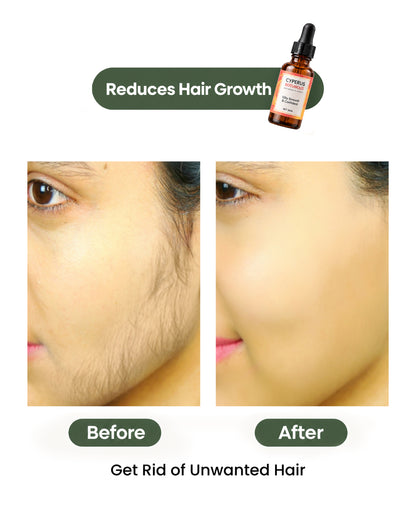 Cyperus Rotundus Oil for Hair Reduction