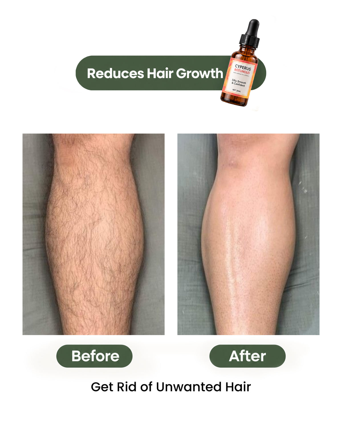 Cyperus Rotundus Oil for Hair Reduction