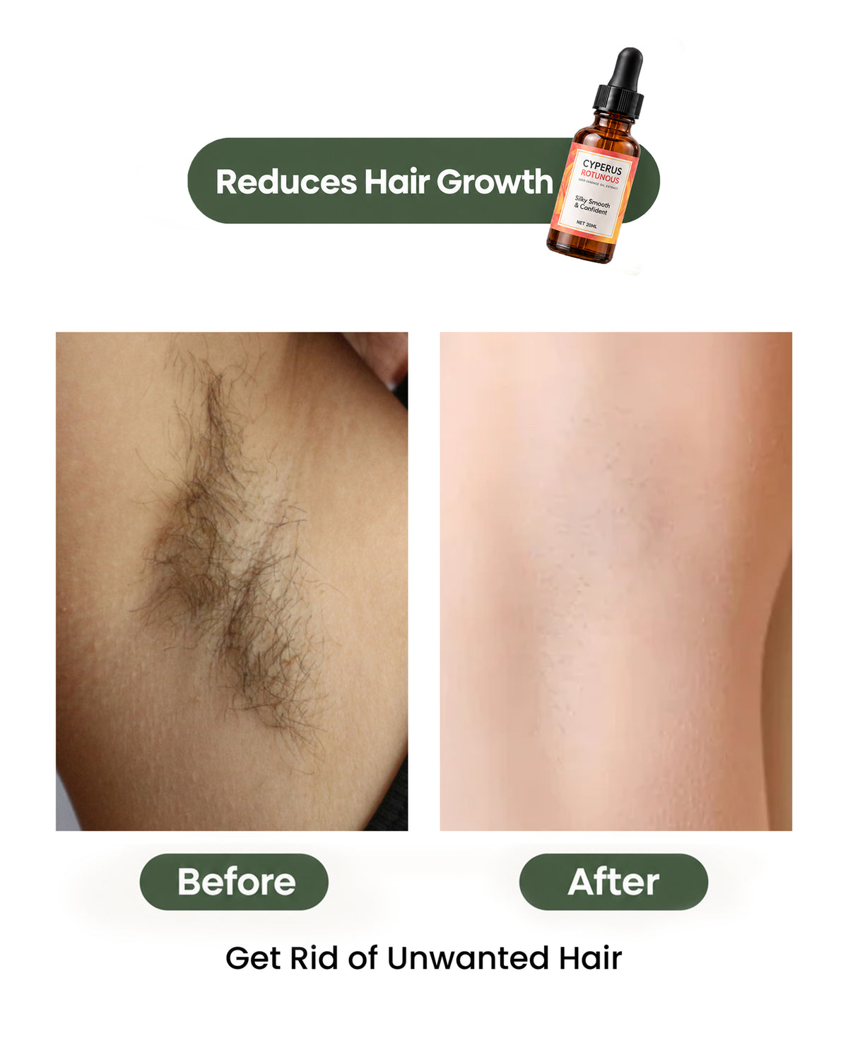 Cyperus Rotundus Oil for Hair Reduction