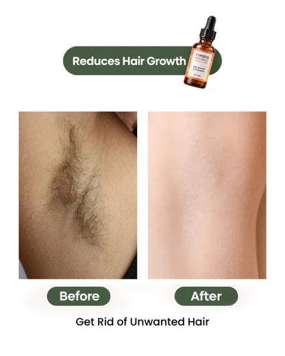 Cyperus Rotundus Oil for Hair Reduction