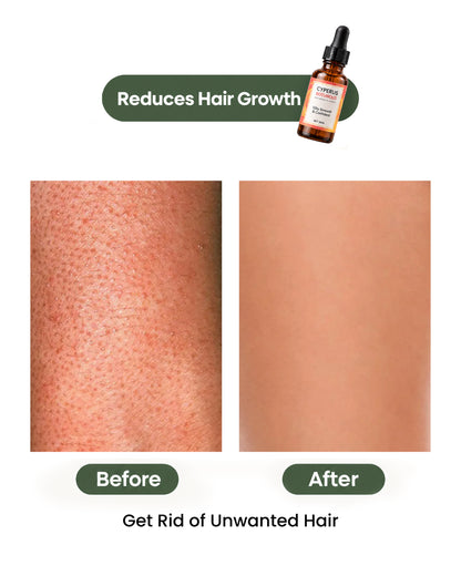 Cyperus Rotundus Oil for Hair Reduction